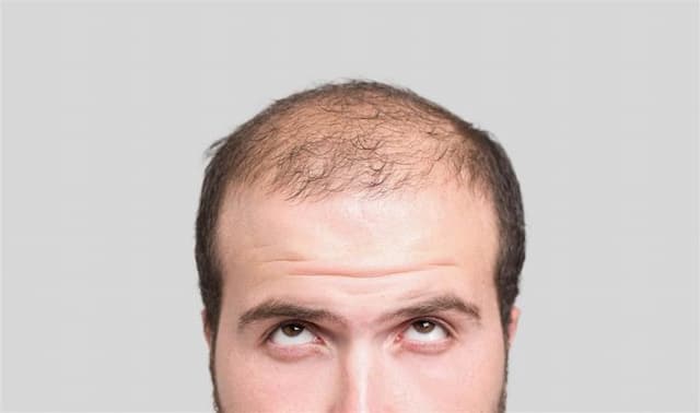 Baldness in men